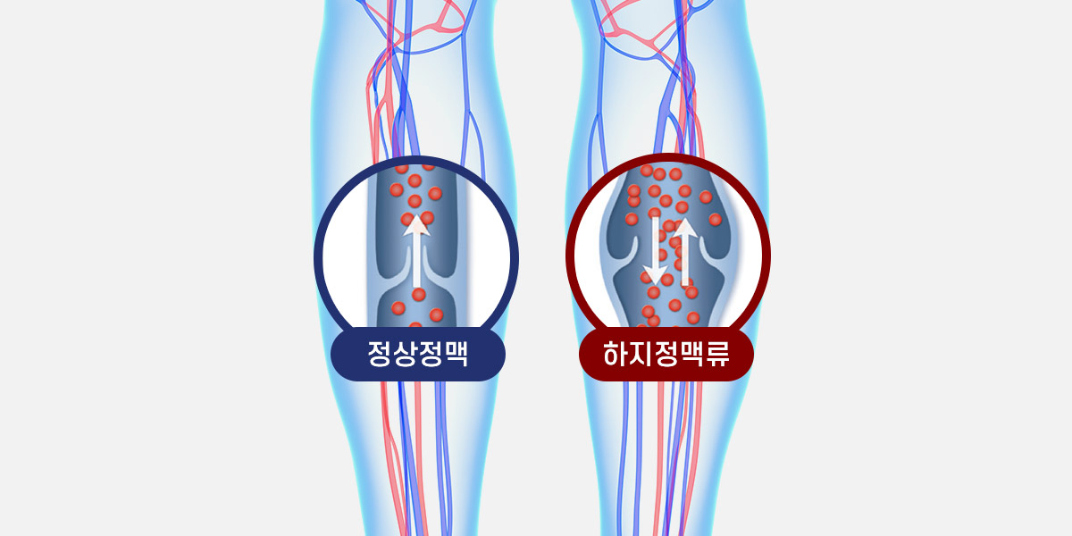 하지정맥류
