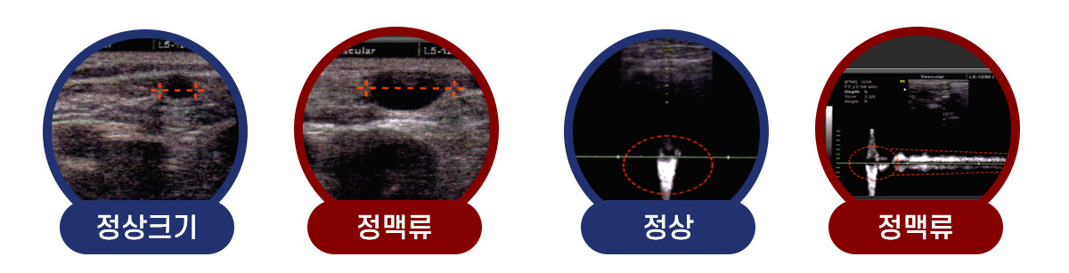 하지정맥류