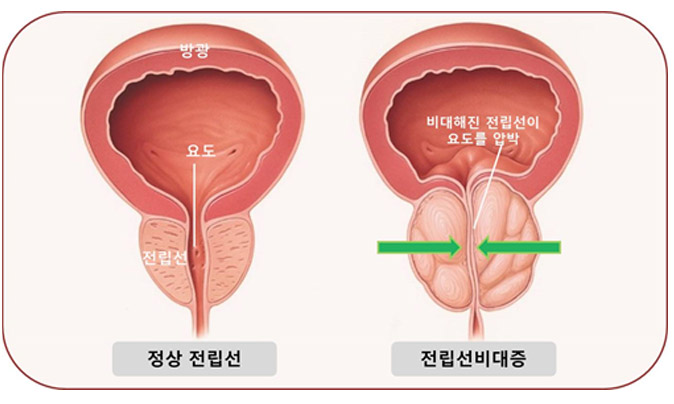 전립선 비대증