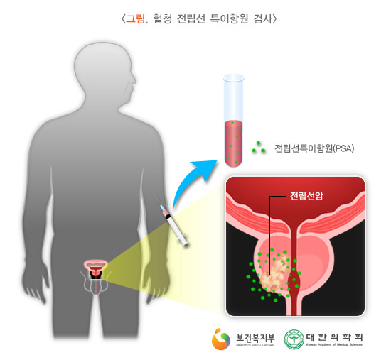 혈청 전립선 특이항원 검사(PSA)