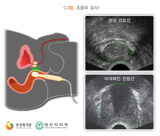 전립선 초음파 검사