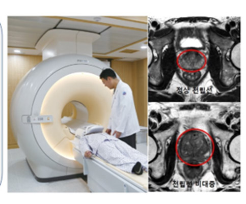 전립선 초음파 검사