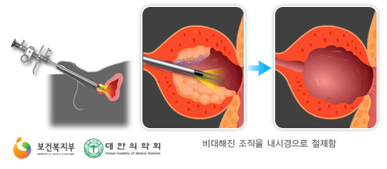 전립선비대증의 수술치료