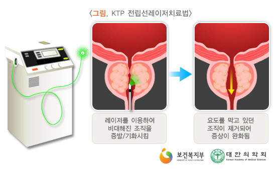 전립선비대증의 레이져 수술 치료