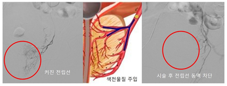 전립선동맥 색전술 시술 과정
