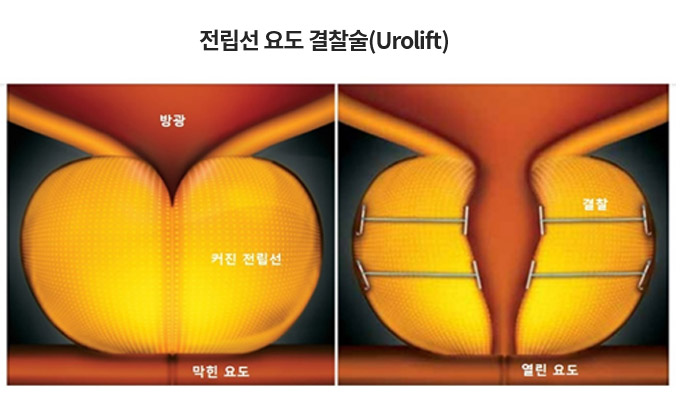 전립선 요도 결찰술(Urolift)