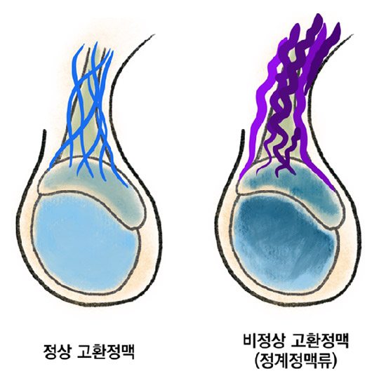 정계정맥류