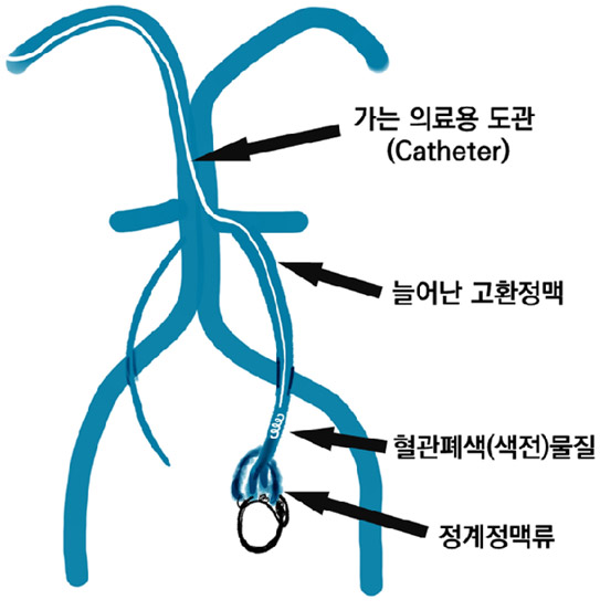 정계정맥류 색전술