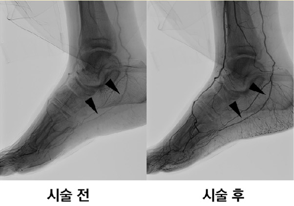 당뇨발 혈관성형술